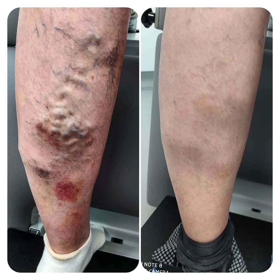 Лечение варикоза ног