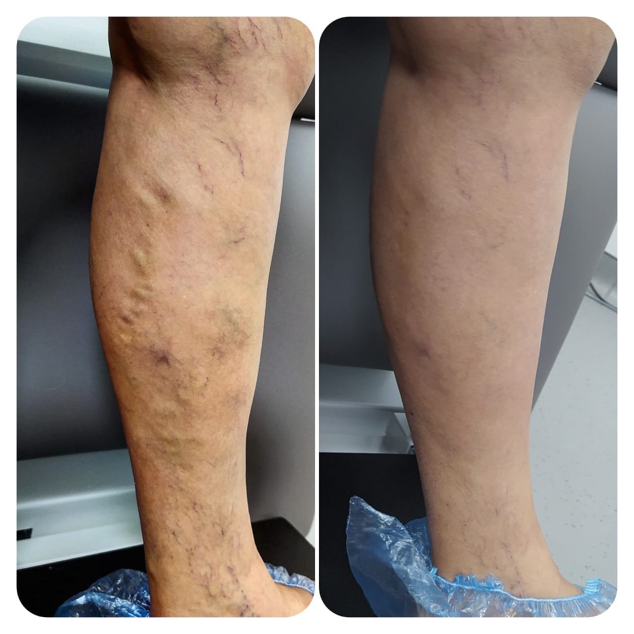 Лечение варикоза ног 1